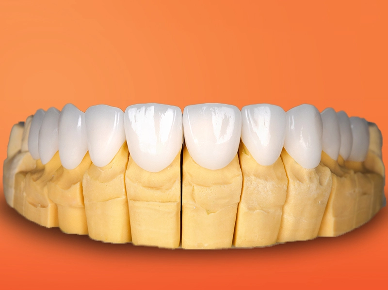 Răng toàn sứ được chế tác hoàn toàn từ 100% sứ nguyên khối cao cấp